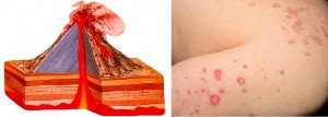 FELITIA Eczemas