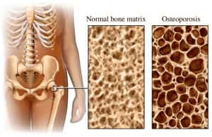 que causa osteoporosis